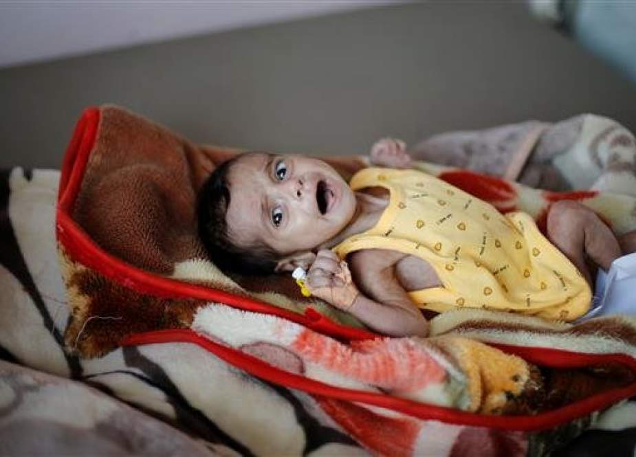 Malnourished child cries at al-Sabeen hospital in Sana