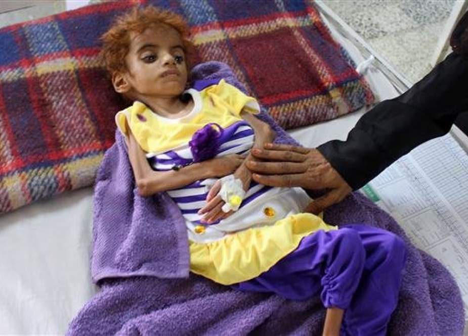 In this file photo taken on September 8, 2018, a Yemeni child suffering from malnutrition receives treatment at a hospital in the northern district of Abs, in Yemen. (Photo by AFP)