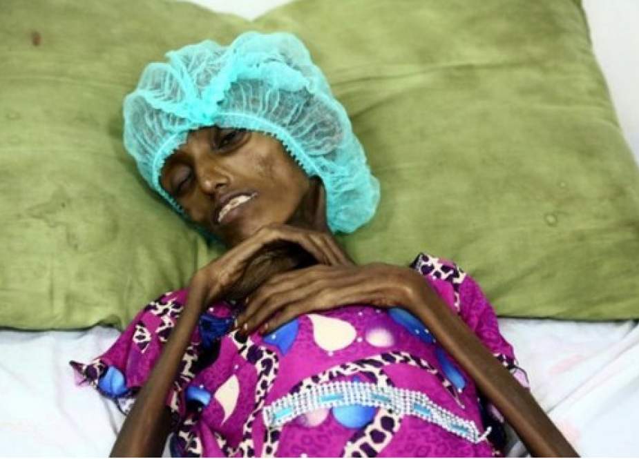 اکثریت زنان باردار در یمن از سوء تغذیه شدید رنج می برند