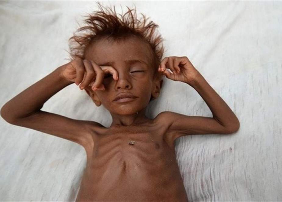Anak Yaman korban kekerasan Saudi Arabia