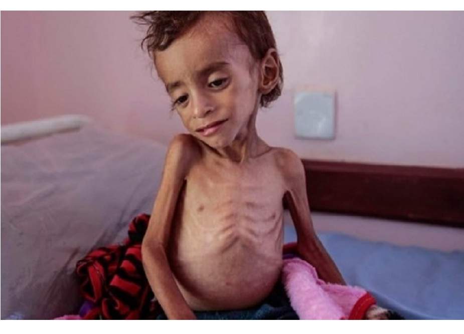 1 کروڑ 97 لاکھ یمنی شہریوں کو فوری طبی امداد کی ضرورت ہے، اقوام متحدہ