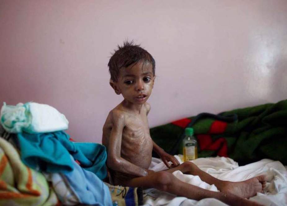 Salah satu anak Yaman penderita malnutrisi (PressTV).