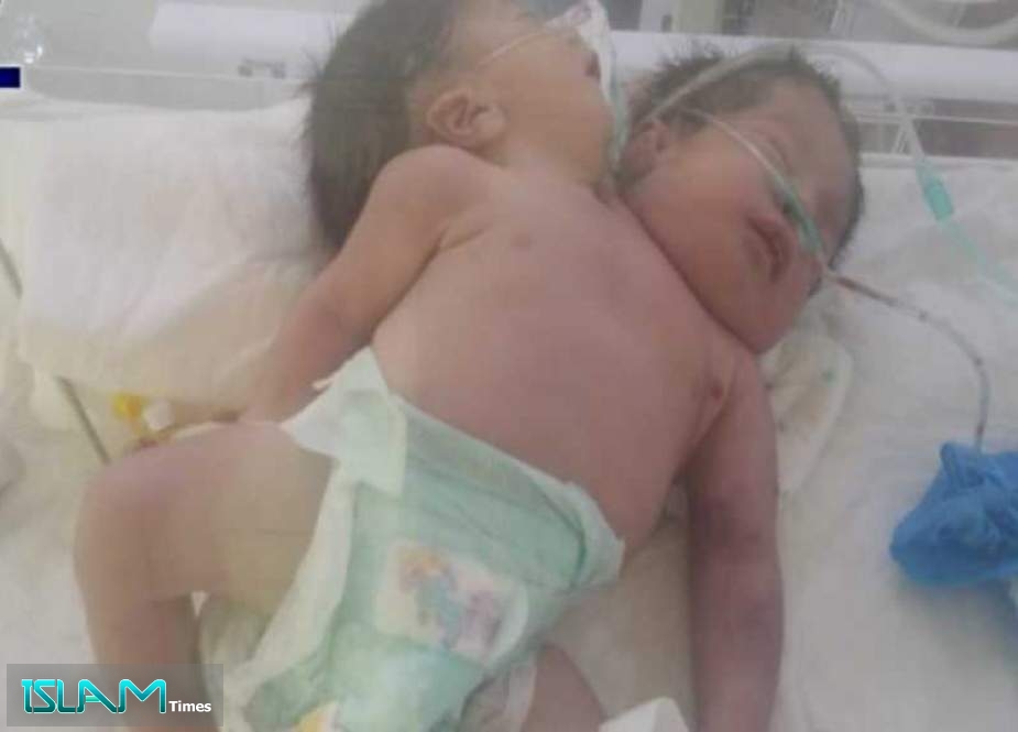 Yemeni Conjoined Twins Die Due to Airport Closure, UN Negligence